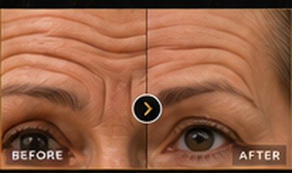 Before and after: forehead lines treatment