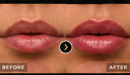 Before and after: lip filler