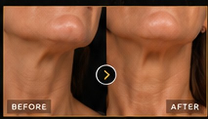 Before and after: neck contouring